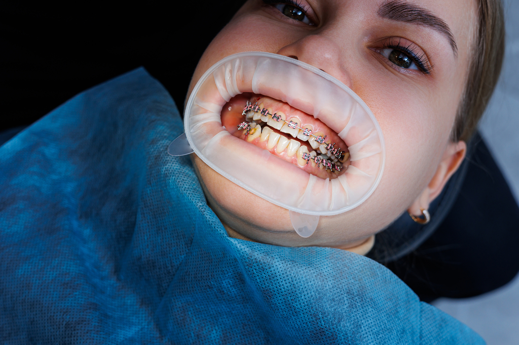 Teeth Straightening