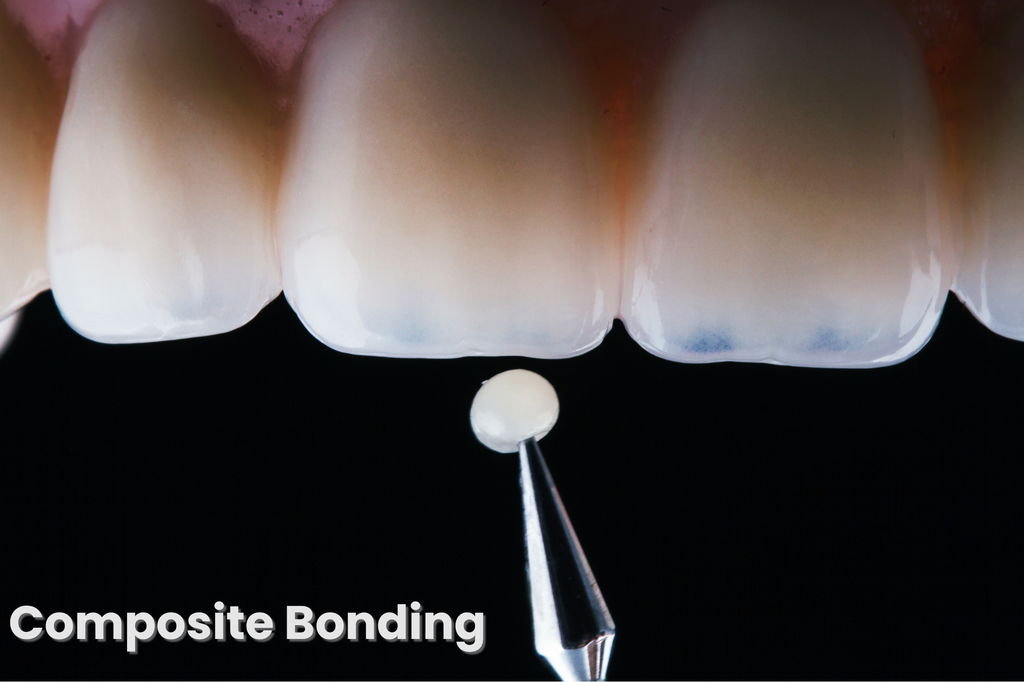 Composite Bonding