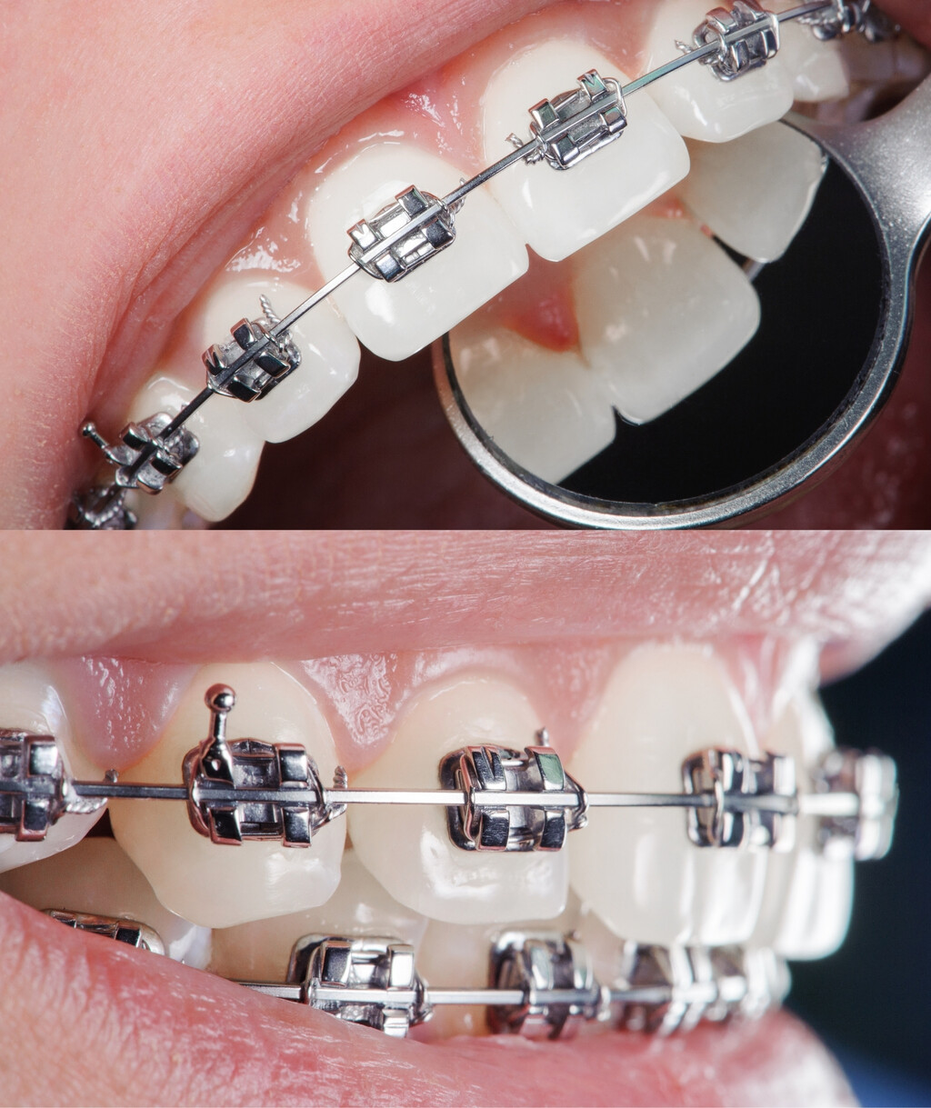 Dental Braces