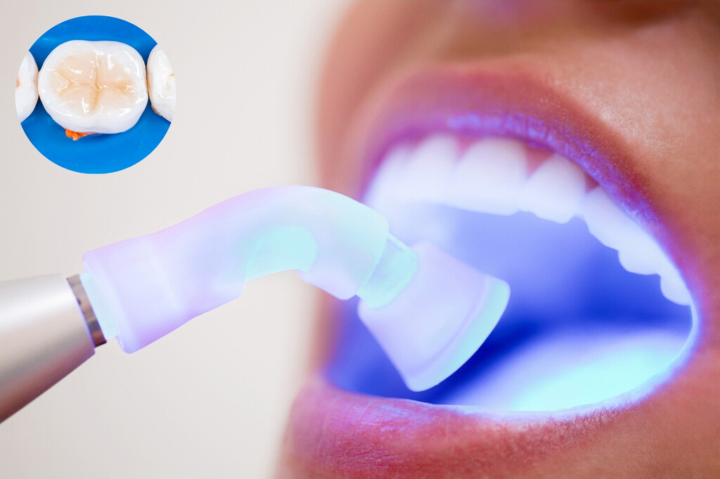 White Fillings