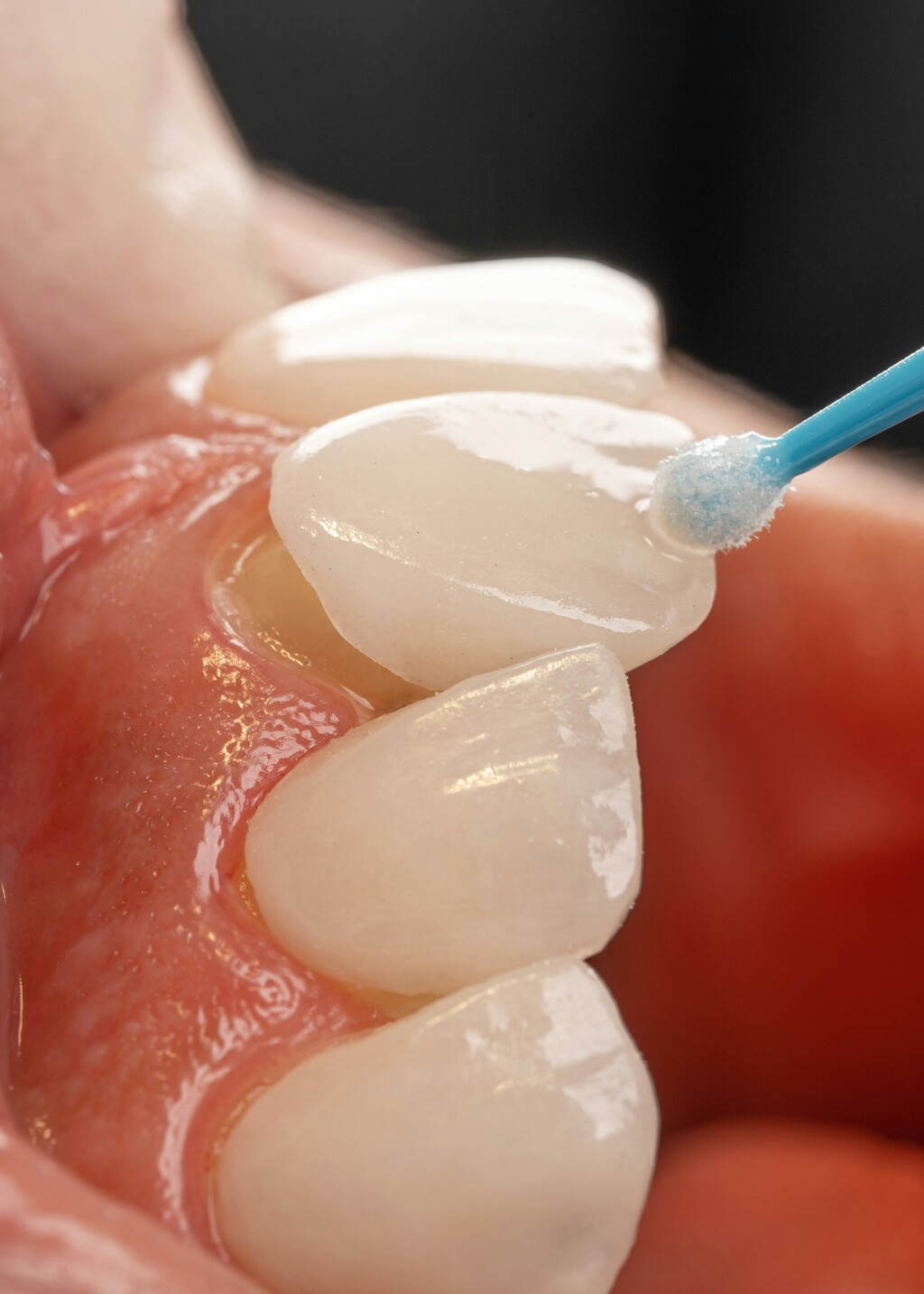 Porcelain Veneers