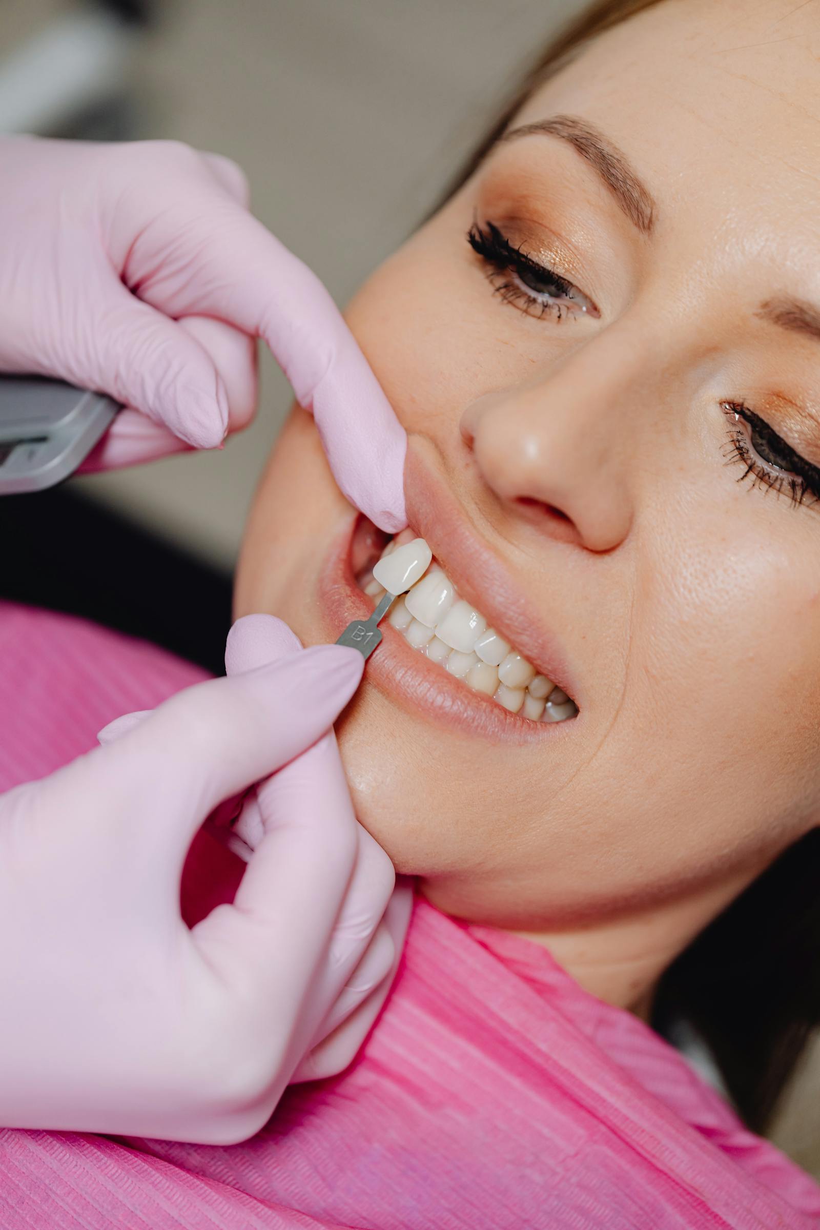 Smile makeover results — porcelain veneers and cosmetic dentistry