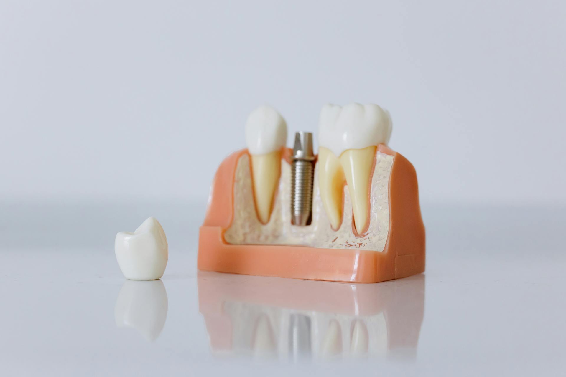 Dental implant model with jaw anatomy