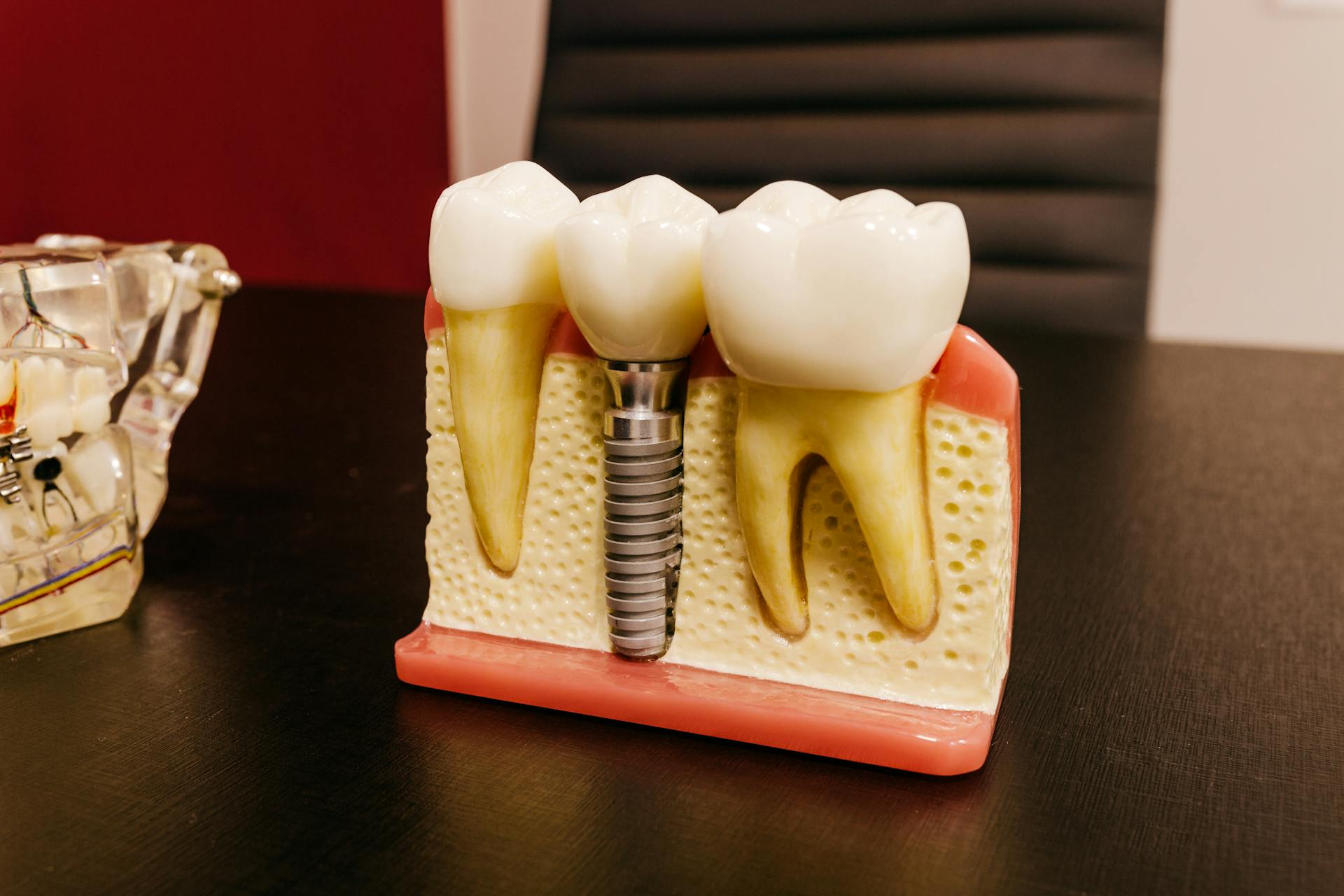 Dental implant results — natural-looking tooth replacement